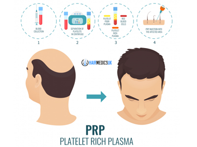 PRP Hair Restoration – Bodika Cosmetic