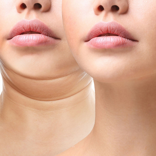 Non-Surgical Double Chin